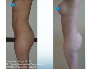Lipo+Lipoiny+Aum