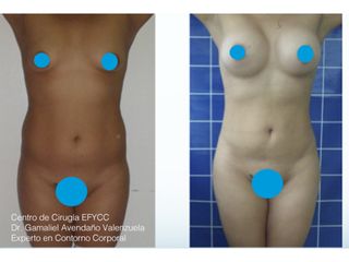 Lipo+Lipoiny+Aum