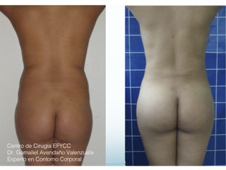Lipo+Lipoiny+Aum