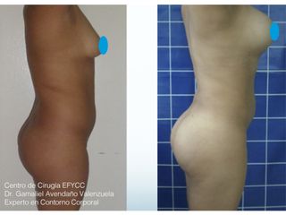 Lipo+Lipoiny+Aum