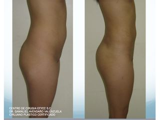 Lipo+Lipoiny+Aum