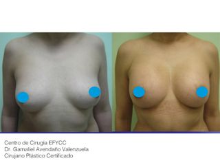 Aumento de Busto