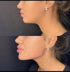 Marcación mandibular - Avanti Aesthetic Clinic