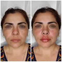 Aumento de labios - Avanti Aesthetic Clinic