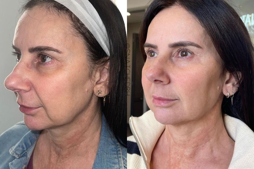 Radiofrecuencia antes y después - 856888