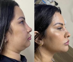 Cirugía de papada - Dra. Mónica Isabel Prieto Bautista