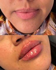 Aumento de labios - Dra. Mónica Isabel Prieto Bautista