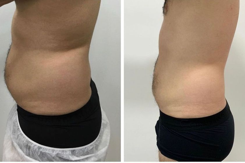 Criolipólisis antes y después - 868942