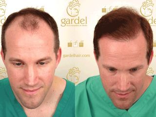 Antes y despues de trasplante de cabello