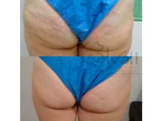 Antes y después de tratamiento Anticelulítico con radiofrecuencia.