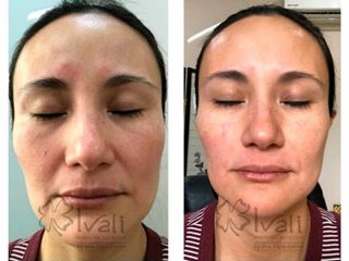 Antes y después de Rejuvenecimiento Facial