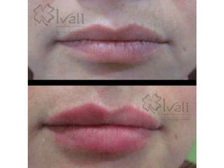 Antes y después de Relleno de Labios 