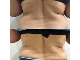 Antes y después de Carboxiterapia
