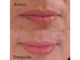 Antes y después de Aumento de labios