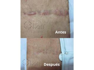 Antes y después de Cirugía para cicatrices (Segunda sesión)