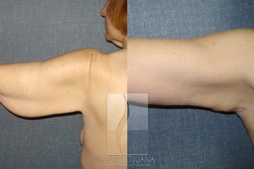 Antes y después de Braquiplastia, Arm lift