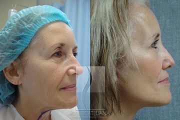 Antes y después de Ritidectomia - Face lift
