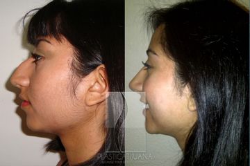 Antes y después de  Rinoplastía - Rhinoplasty