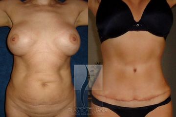 Antes y después de Abdominoplastía - Tummy tuck