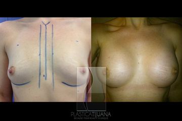 Antes y después de Aumento mamario - Breast augmentation