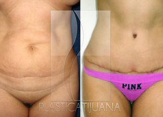 Antes y después de Abdominoplastia - Tummy Tuck