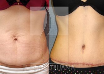 Antes y después de Abdominoplastia - Tummy Tuck
