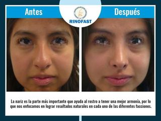 Antes y después de Rinoplastia