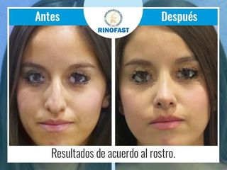 Antes y después de Rinoplastia