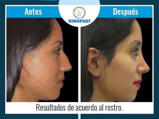 Antes y después de Rinoplastia