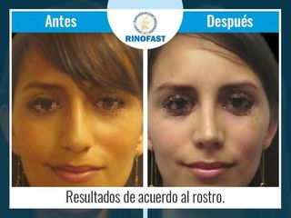 Antes y después de Rinoplastia