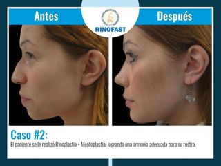 Antes y después de Rinoplastia + Mentoplastia