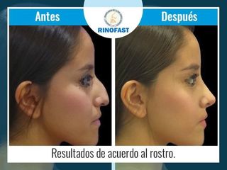 Antes y después de Rinoplastia