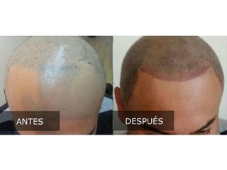 Antes y después de Trasplante de cabello
