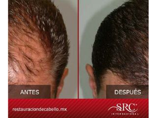 Antes y después de Trasplante de cabello