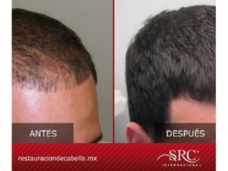 Antes y después de Trasplante de cabello