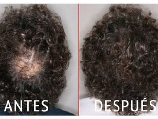 Antes y después de Micropigmentación capilar