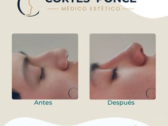 Rinomodelación antes y después - 880545