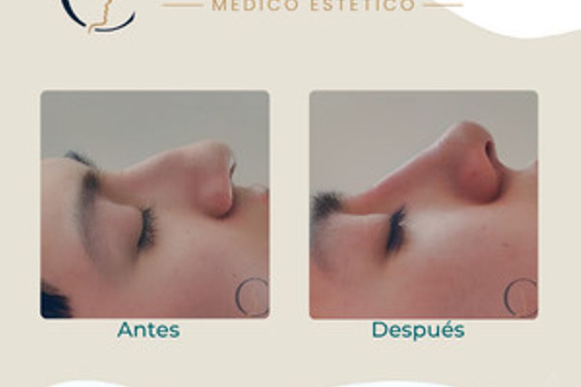 Rinomodelación antes y después - 880545