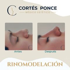 Rinomodelación - Dr. Andrés Raúl Cortés Ponce
