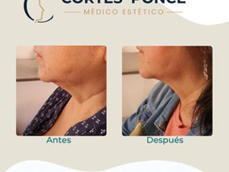 Toxina botulínica antes y después - 880547