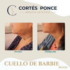 Toxina Botulínica - Dr. Andrés Raúl Cortés Ponce