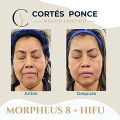 HIFU - Dr. Andrés Raúl Cortés Ponce