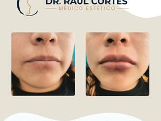 Aumento de labios antes y después - 880588