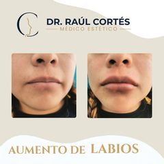Aumento de Labios - Dr. Andrés Raúl Cortés Ponce