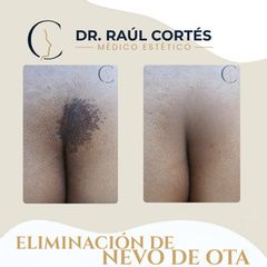 Eliminación de Nevo de Ota - Dr. Raúl Cortés