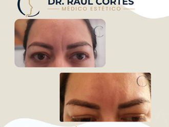 Toxina botulínica antes y después - 880590