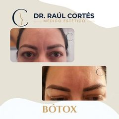 Toxina Botulínica - Dr. Andrés Raúl Cortés Ponce