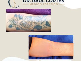 Eliminación de tatuajes antes y después - 880591