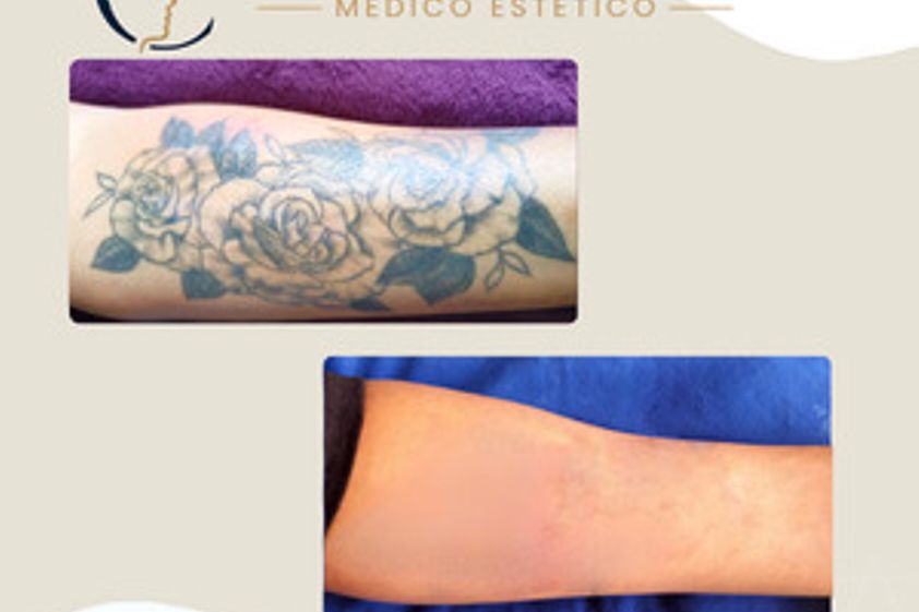 Eliminación de tatuajes antes y después - 880591