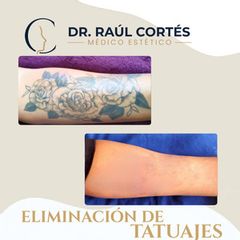 Eliminación Tatuajes -Dr. Andrés Raúl Cortés Ponce